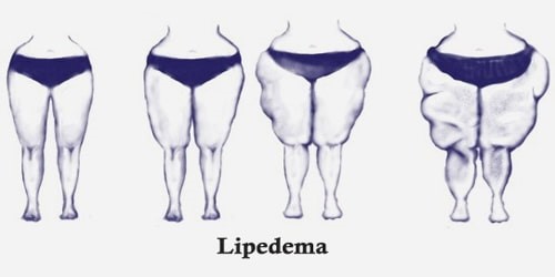 Limfedem i lipedem